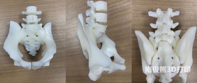 3D打印技術(shù)助力脊柱手術(shù)，讓患者重獲新生